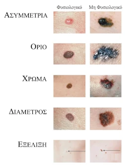 καρκινος δερματος σημαδια