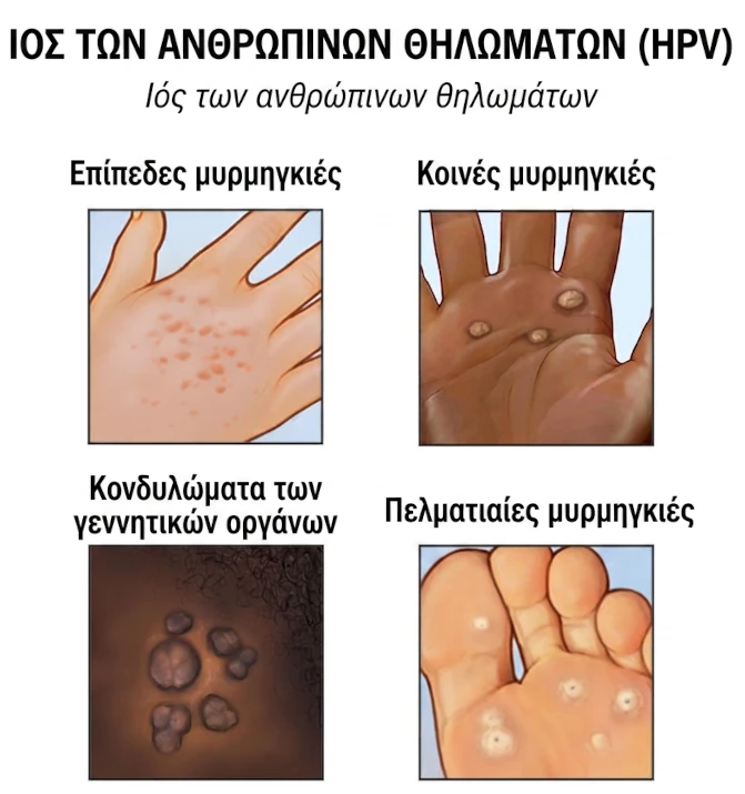 τύποι κονδυλωμάτων hpv