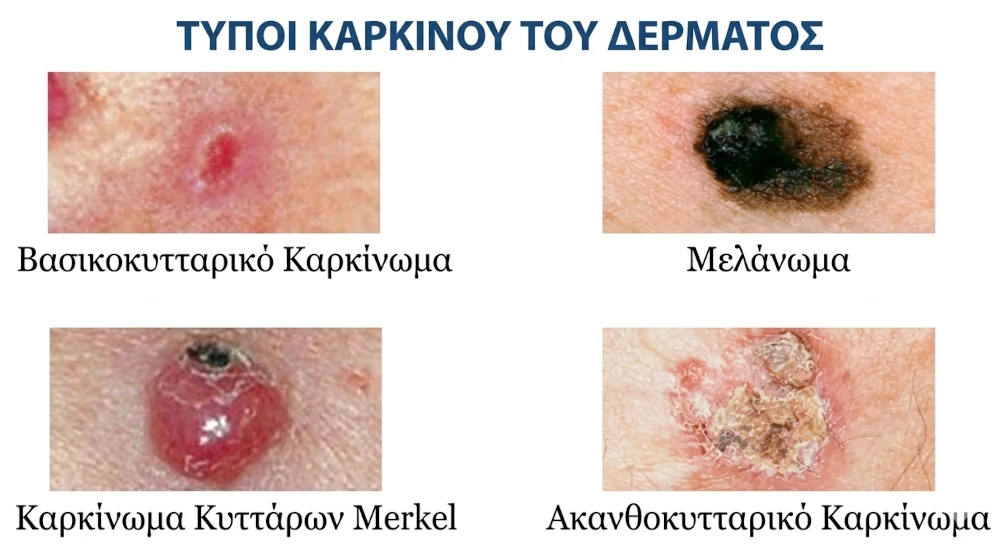 τύποι καρκίνου δέρματος